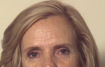 CO2 Laser Resurfacing before 112801