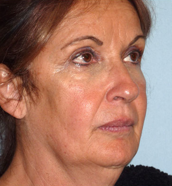 Facelift before 1072029