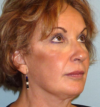 Facelift after 1072029