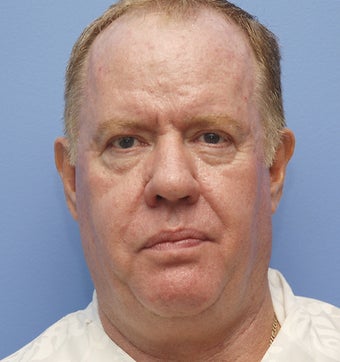 Lower Lid Blepharoplasty, Facelift, Non-Surgical Chin Augmentation, Cheek Augmentation, Neck Liposuction before 488003