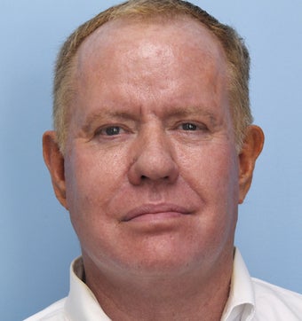 Lower Lid Blepharoplasty, Facelift, Non-Surgical Chin Augmentation, Cheek Augmentation, Neck Liposuction after 488003