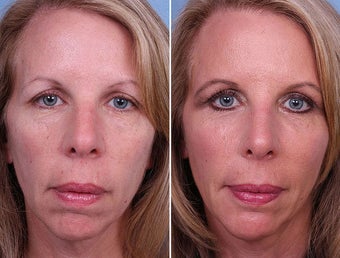 Radiesse, Cheek and Chin Augmentation before 242548