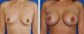 Flash Recovery Breast Augmentation (TM) before 256405