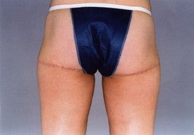 Thigh Lift after 891458
