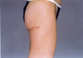 Thigh Lift 891458