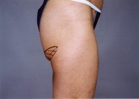Thigh Lift 891458
