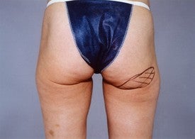 Thigh Lift before 891458