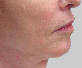Exilis after 849406