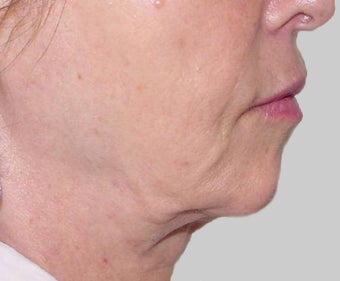 Exilis before 849406