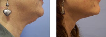 Face and Neck Lift before 220927