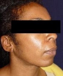 Radiesse for Smile Lines after 909690