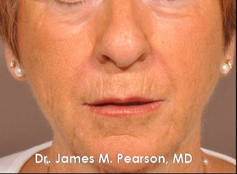 Injectable Filler Treatment after 910407
