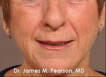Injectable Filler Treatment before 910407