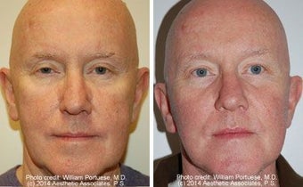 Facelift before 91471