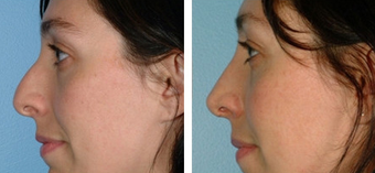 Functional Rhinoplasty before 1208317