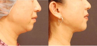 Chin and Jaw liposuction with SlimLipo before 684490