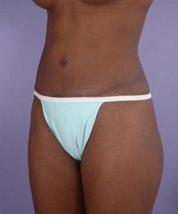 Tummy Tuck after 280057