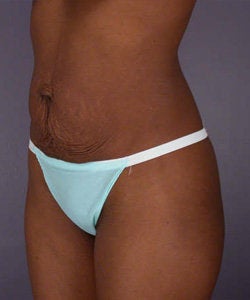 Tummy Tuck before 280057