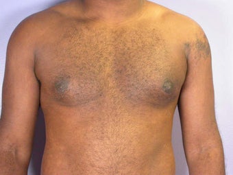 Male Breast Reduction after 285196