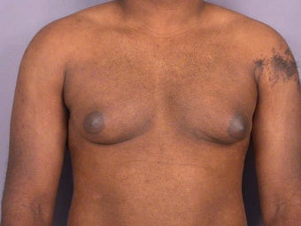 Male Breast Reduction before 285196