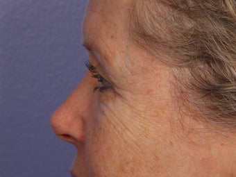 Eyelid Surgery after 280839