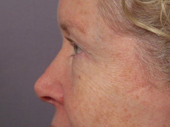 Eyelid Surgery before 280839