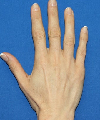 Hand Rejuvenation with Filler before 817098