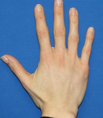 Hand Rejuvenation with Filler after 817098