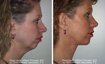 Facelift with Chin Implant, Dermabrasion before 91416