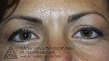 Botox to Glabella (Frown Lines) before 315161