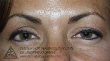 Botox to Glabella (Frown Lines) after 315161
