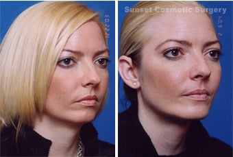Submental Liposuction (chin/neck) with Chin Implant after 255547