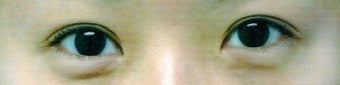 Bilateral Asian Eyelid Surgery w/ Medial Epicanthoplasty after 861194