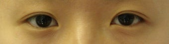Bilateral Asian Eyelid Surgery w/ Medial Epicanthoplasty before 861194