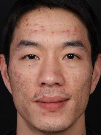 Isolaz for Acne 539868