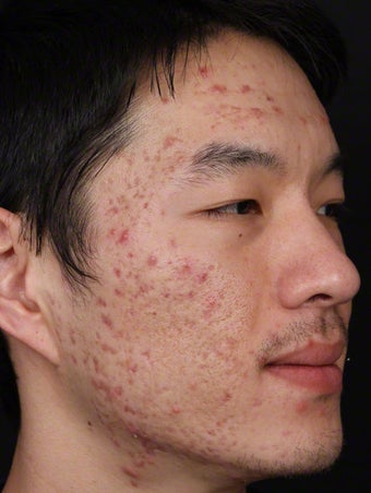 Isolaz for Acne before 539868