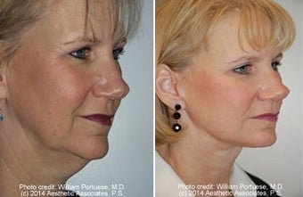 Face lift with dermabrasion before 91406