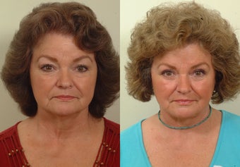 Lower facelift and eyelids before 120220