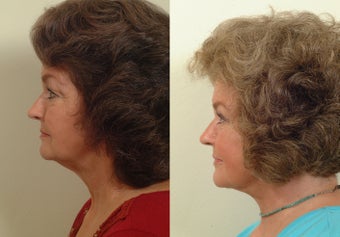 Lower facelift and eyelids after 120220