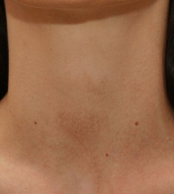 VBeam for Redness and Bruising after 138491