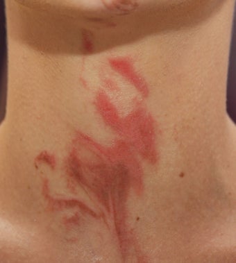 VBeam for Redness and Bruising before 138491