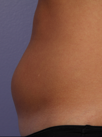 CoolSculpting by Zeltiq to abdomen before 375503