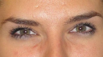 Botox after 959527