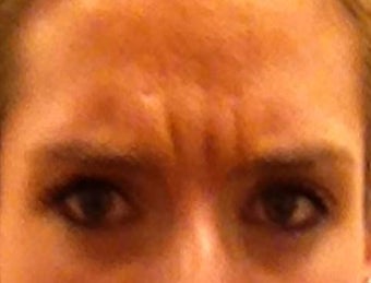 Botox before 959527