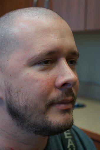 Male Liquid Eyelid Lift for Bags 923522