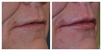Middle Aged Female Who Wanted Lips before 1367243