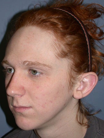 Otoplasty/Ear Surgery before 731973