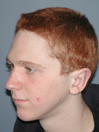 Otoplasty/Ear Surgery after 731973