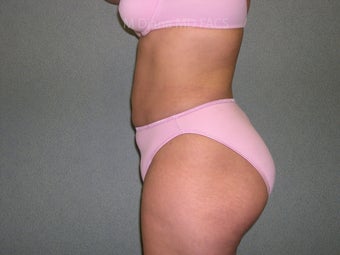 SmartLipo 607523