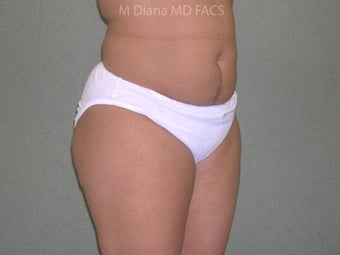 SmartLipo before 607523